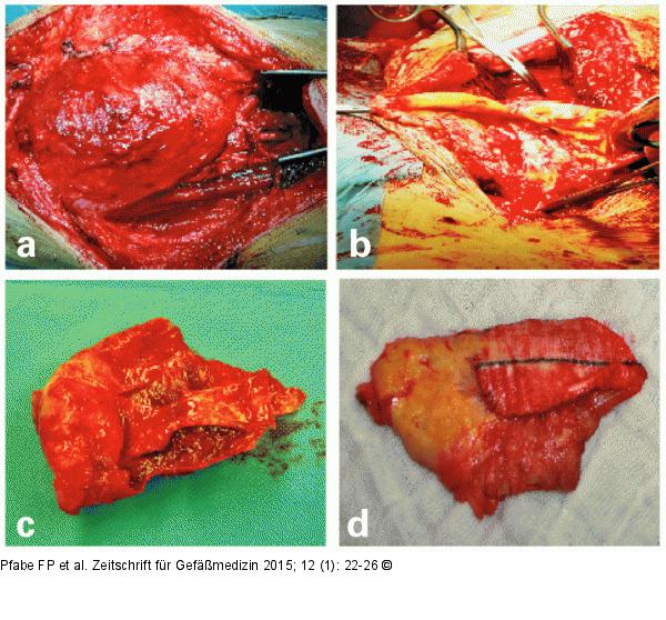Aneurysma