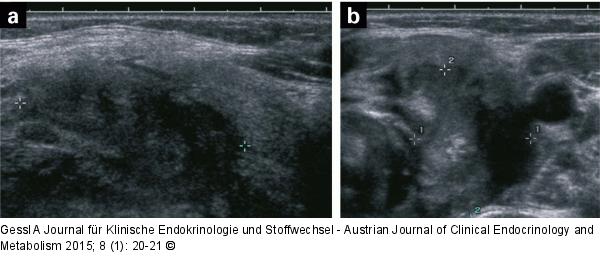 Thyreoiditis