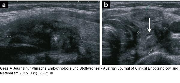 Thyreoiditis