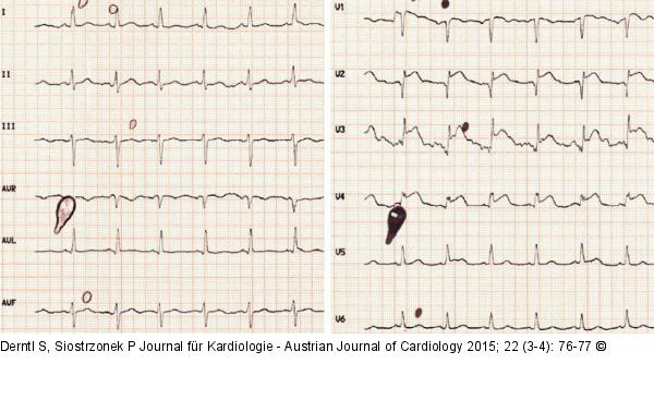 ECG