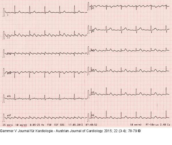 EKG