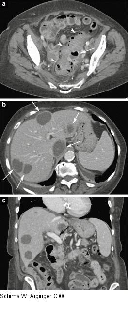 MDCT - Leber