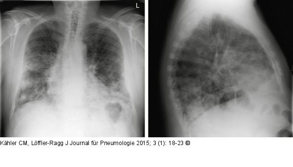 Medikamentenassoziierte diffuse parenchymatöse Lungenerkrankung - DILD