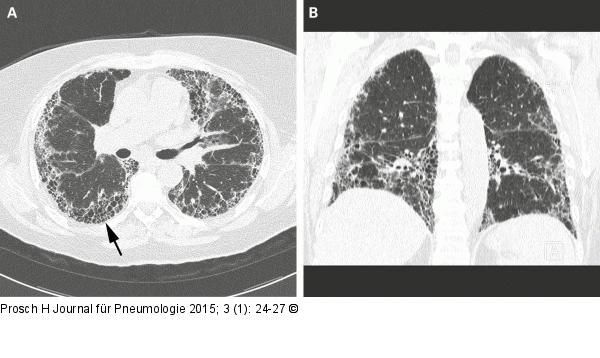 Usual Interstitial Pneumonia - UIP