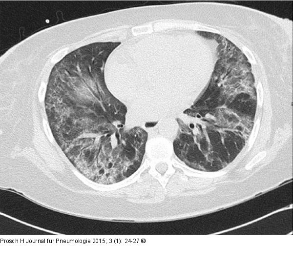 Non-specific Interstitial Pneumonia - NSIP