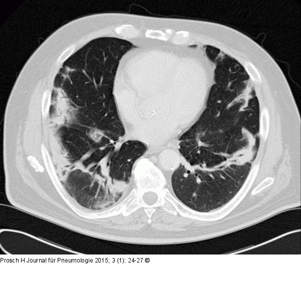 Pneumonie