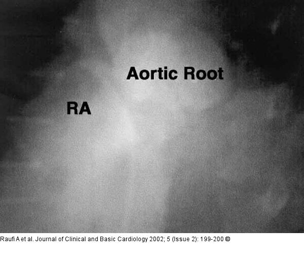 Sinus-Valsalvae-Aneurysma