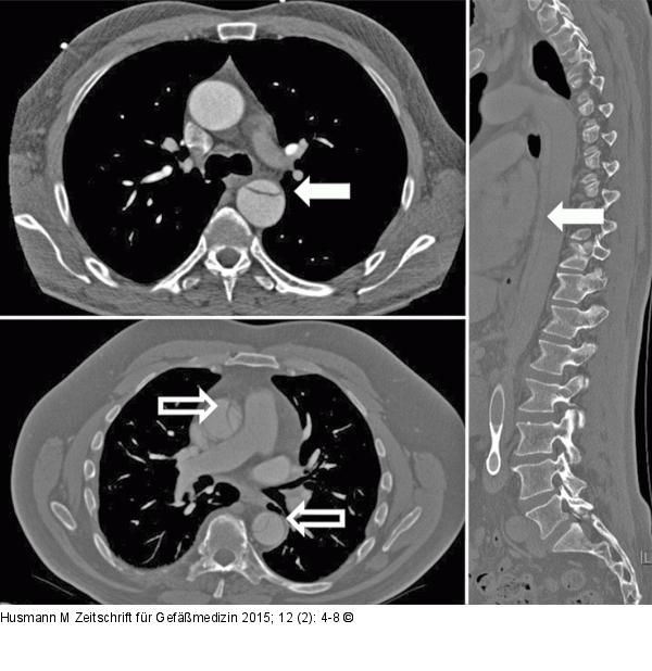 Aorta