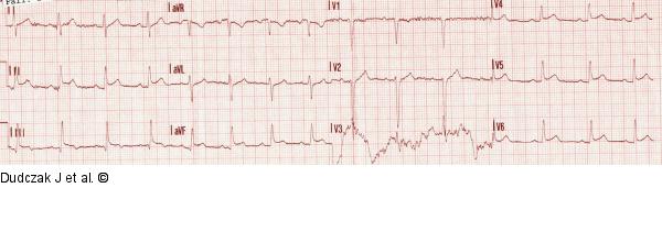 Präklinisches EKG