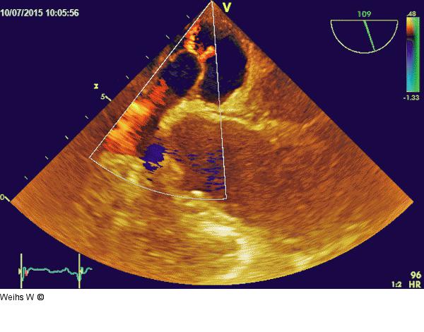 Vorhofseptumaneurysma