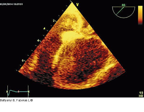 Thromboemolus