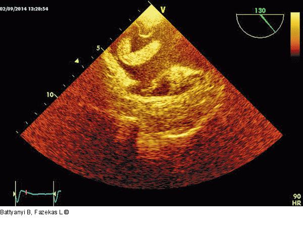 Thromboembolus
