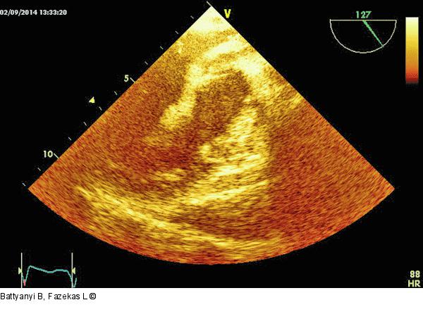 Thromboembolus
