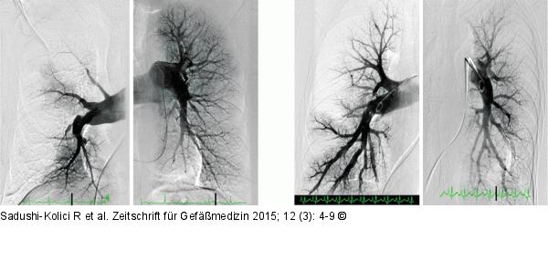 Pulmonalgefäßangiographie