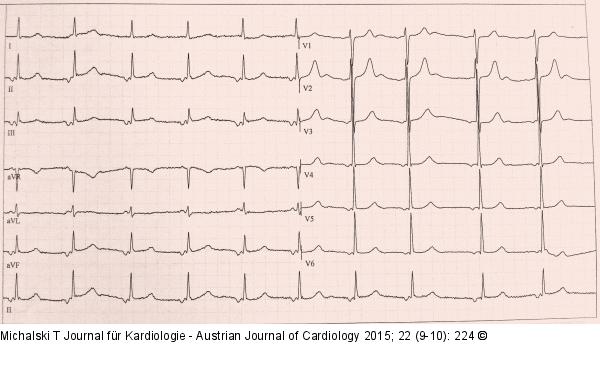 EKG