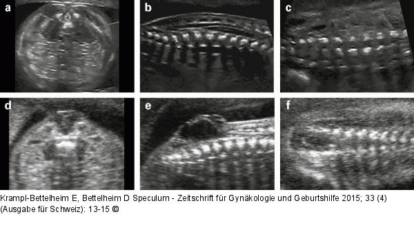 Spina bifida – Pränataldiagnose