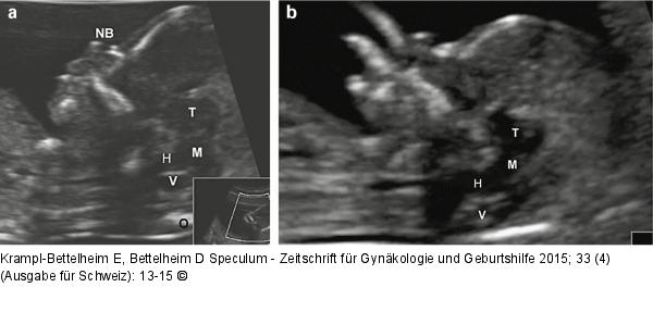 Spina bifida – Pränataldiagnose