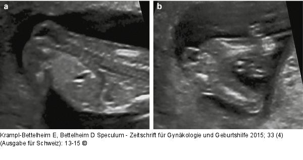 Spina bifida – Pränataldiagnose