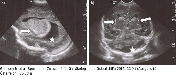 Schädelsonographie