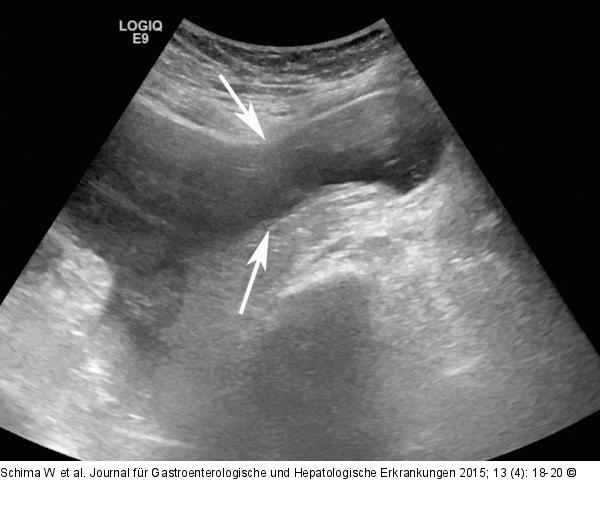 Sonographie - Bauchpforte