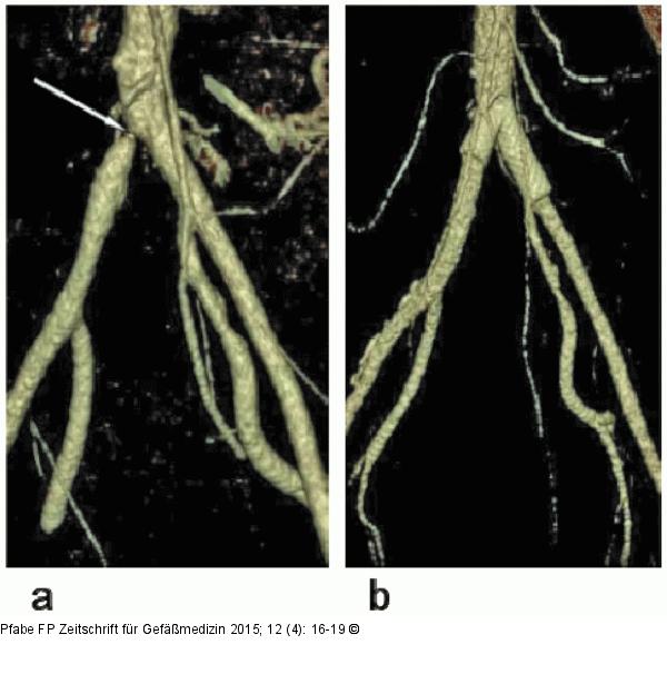 Becken-Arterien