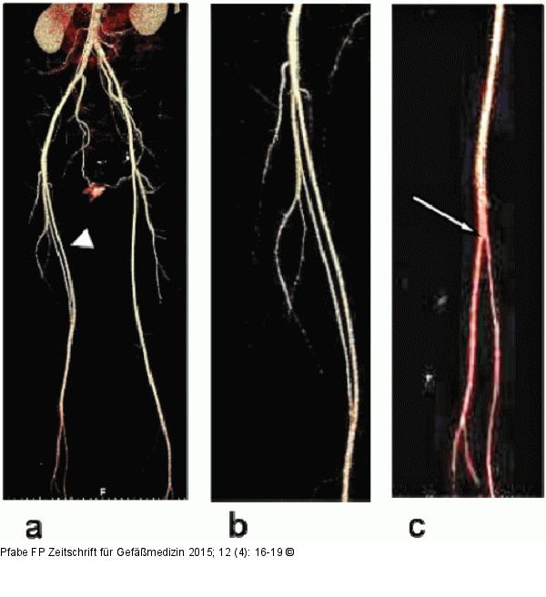 Aortenbifurkation