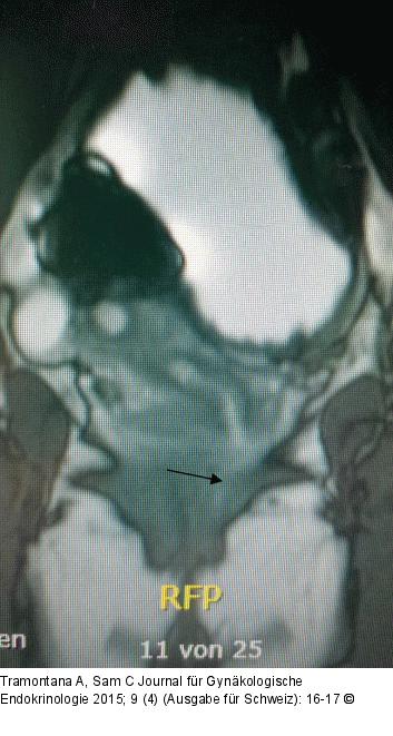 Vaginalstenose