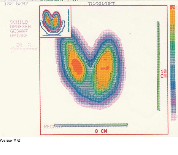 Hyperthyreose