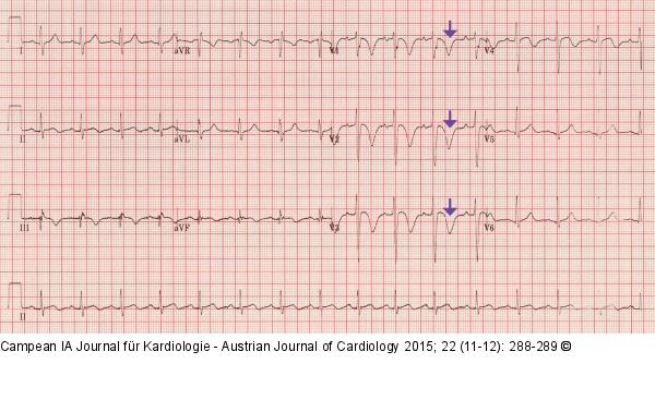 EKG