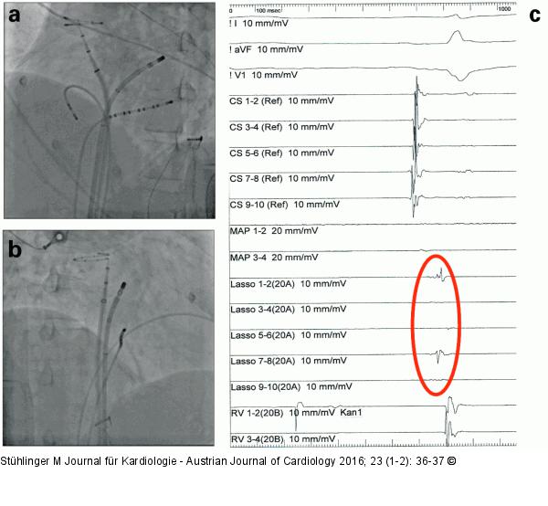 Pulmonalvenen - Lasso-Katheter