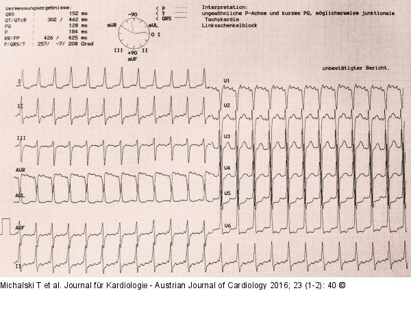 EKG