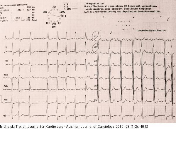 EKG
