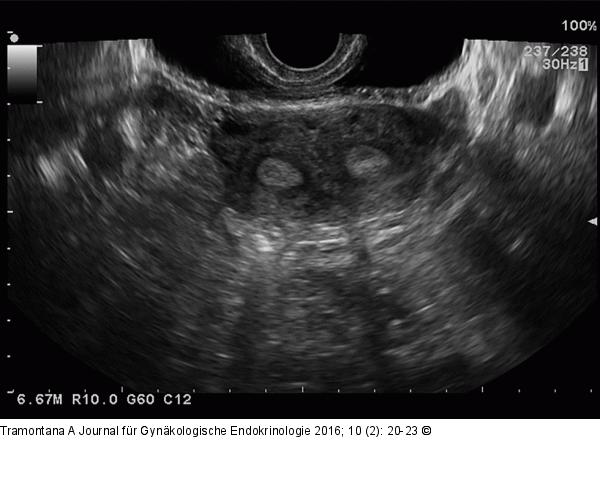 Uterus subseptus