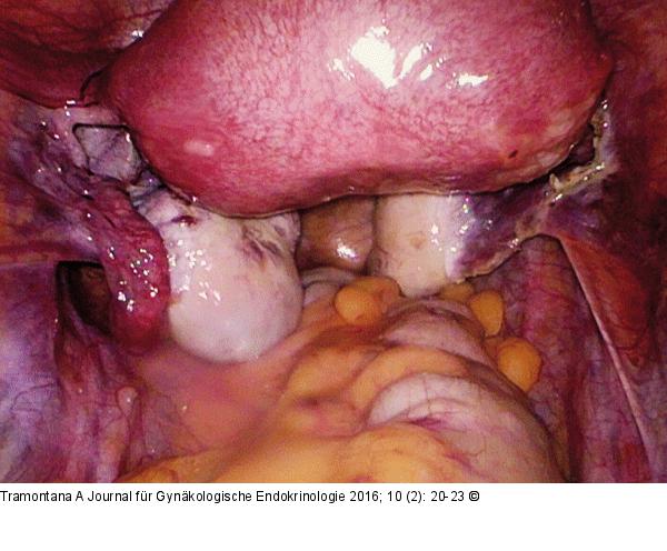 Uterus subseptus