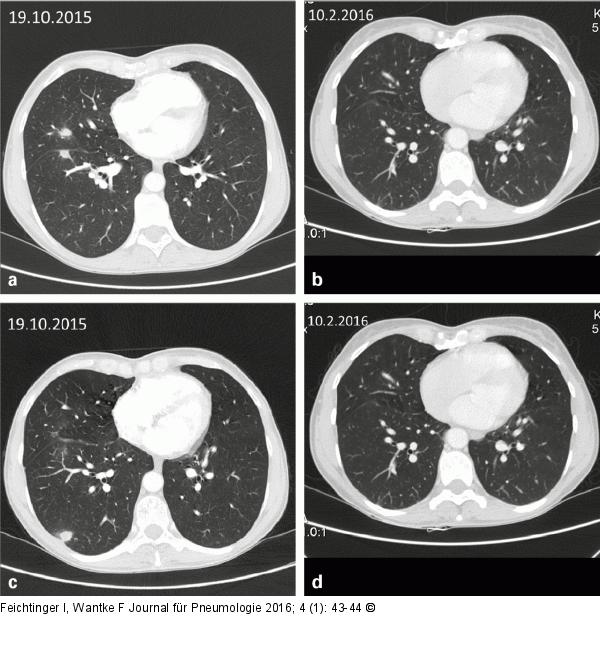 Pulmonalembolie