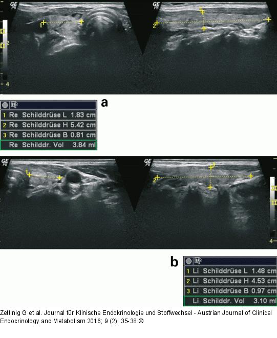 Subakute Thyreoiditis