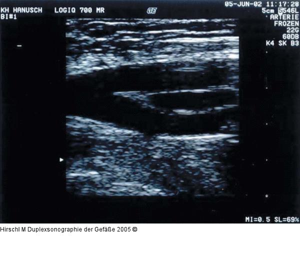 Duplexsonographie - Karotis
