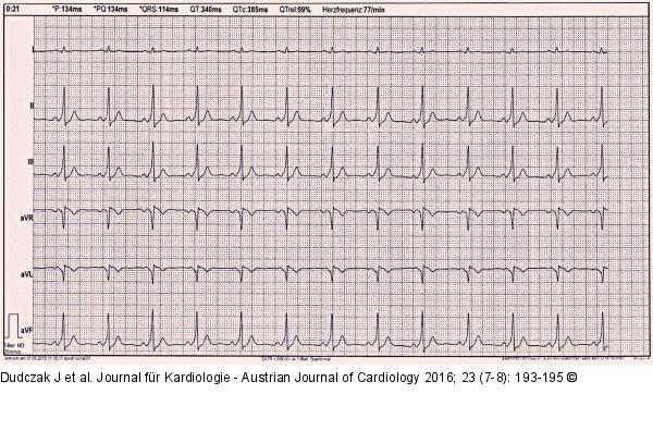 EKG