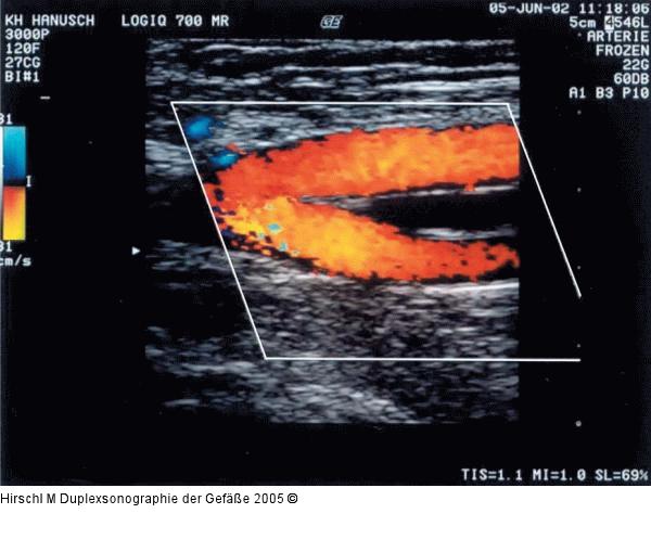 Duplexsonographie - Arteria femoralis communis