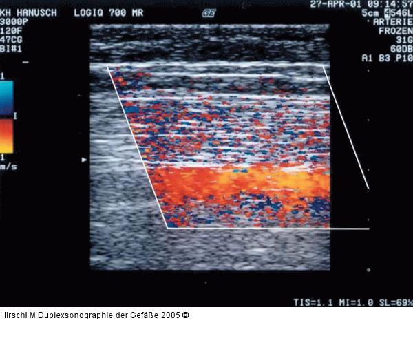 Duplexsonographie - Farbgain