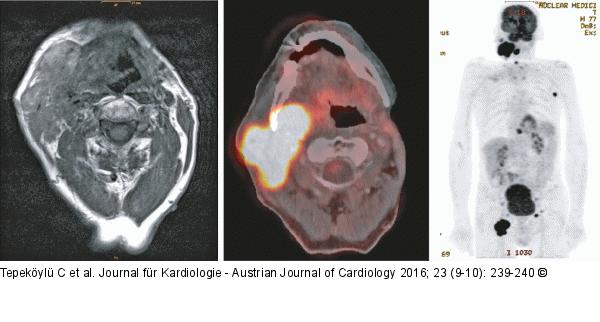 MRI - PET-CT