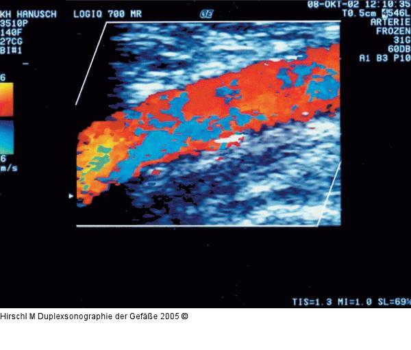 Duplexsonographie - Biphasisches Flußsignal