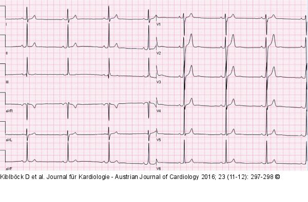 EKG