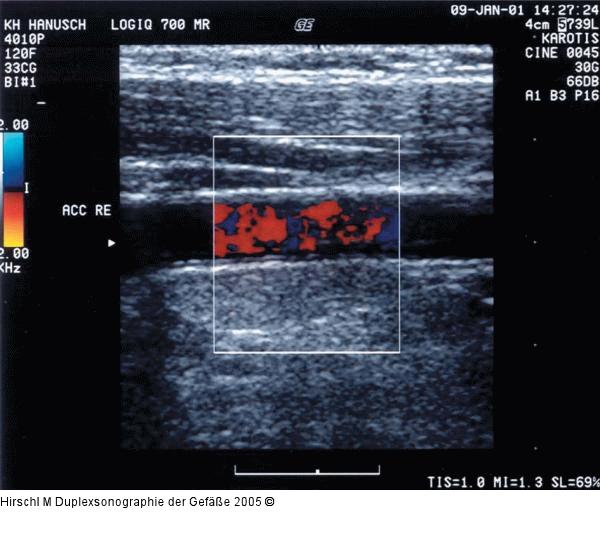 Duplexsonographie - Farbfenstereinstellung