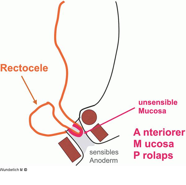 Anteriorer Mukosaprolaps