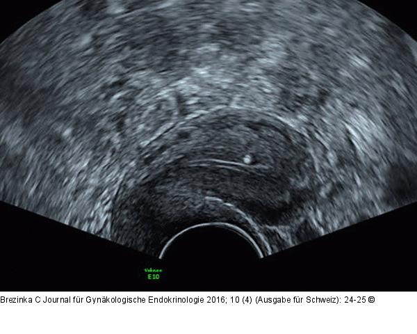 Subendometriale Fibrose