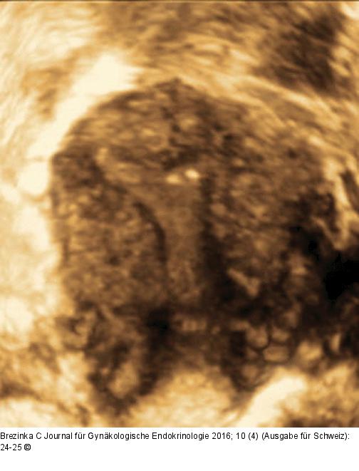 Subendometriale Fibrose