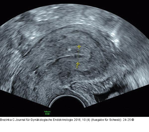 Subendometriale Fibrose