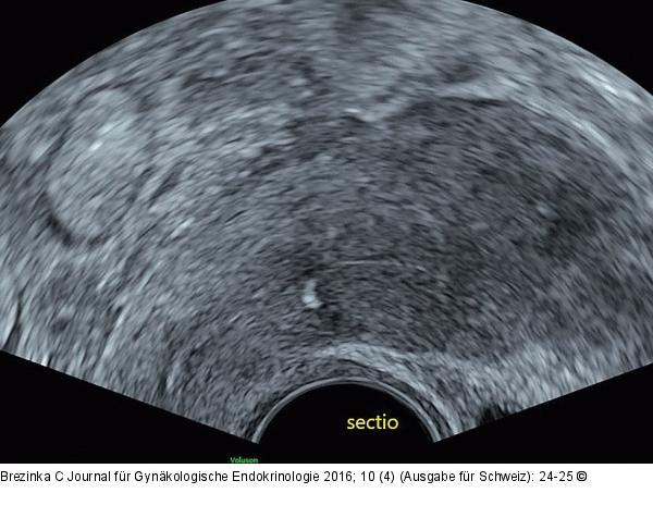 Subendometriale Fibrose