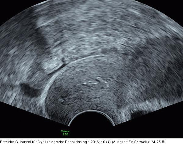 Subendometriale Fibrose